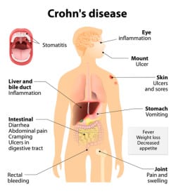 Crohn Disease