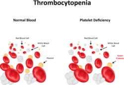thrombocytopenia and pregnancy new york