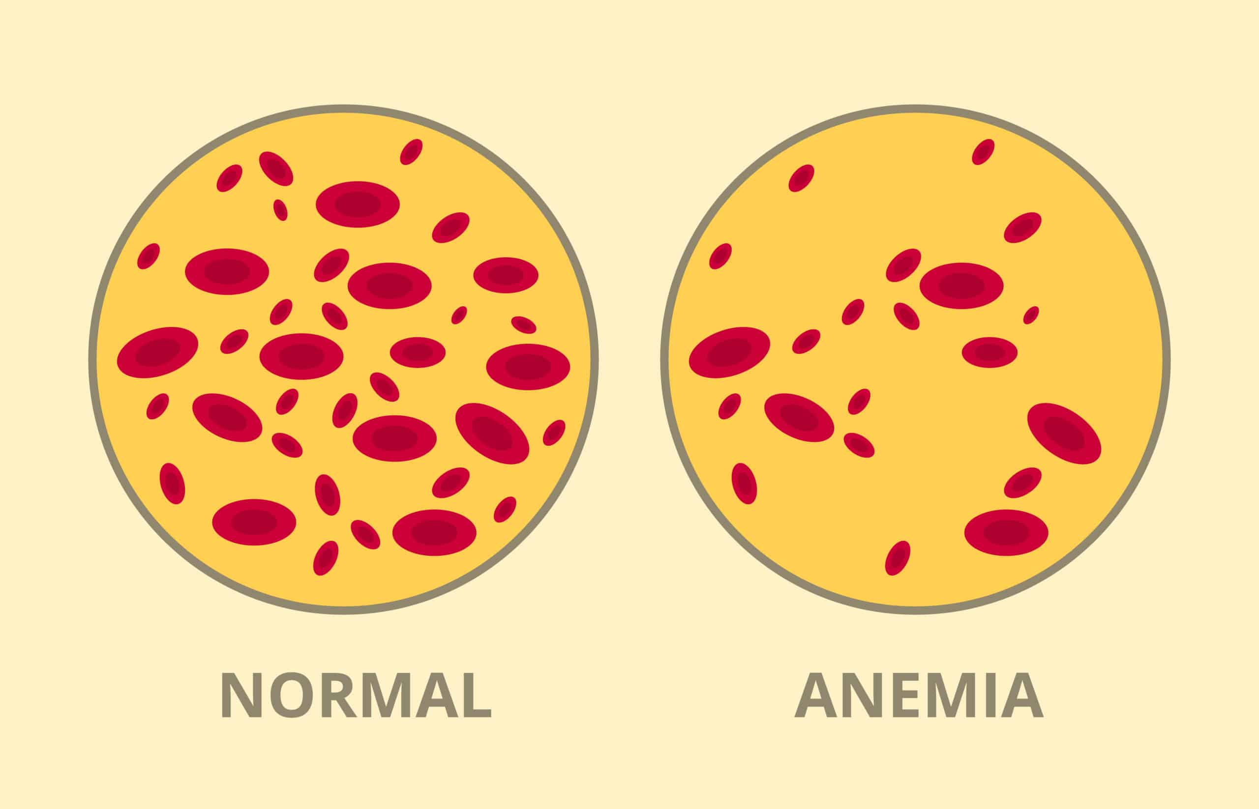 Анемия и эритроциты в крови. Анемия рисунок. Анемия эритроциты. Эритроциты в крови анемия.